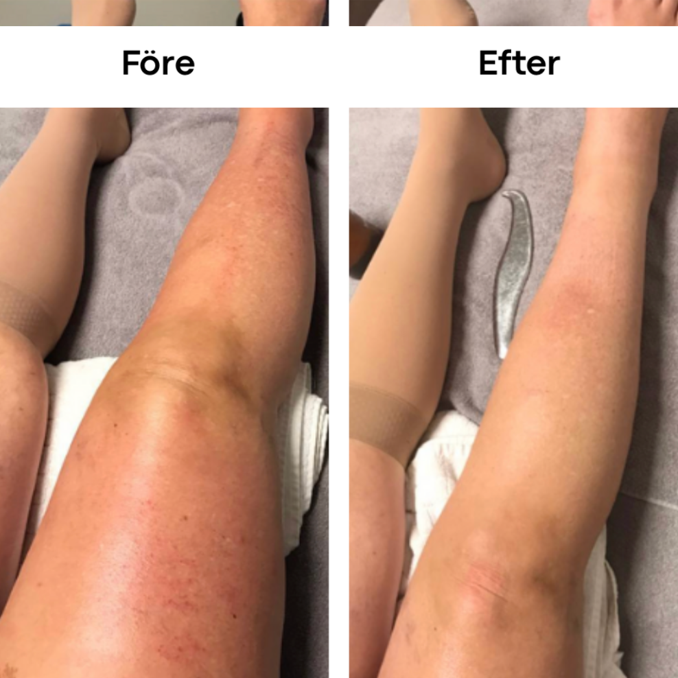 LYMORA™ Knämassager - Frihet och lätthet för dina ben